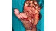 India News | Doctors Reconstruct Thumb from 20-year-old Man's Amputated Leg in Delhi