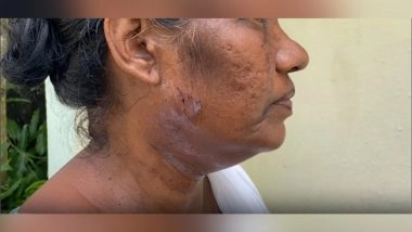 India News | Kerala SIR Exercise: Booth Level Officer Suffers Injuries After Kottayam Local Sets Dog on Her