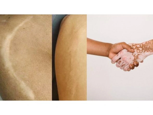 Business News | Scar and Vitiligo Treatment in Mumbai, Vitiligo and Scar Treatment Clinic in Mumbai - BrowMaster