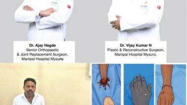 Business News | Manipal Hospitals' Mysuru Team Successfully Performs Life-Saving Hand Replantation