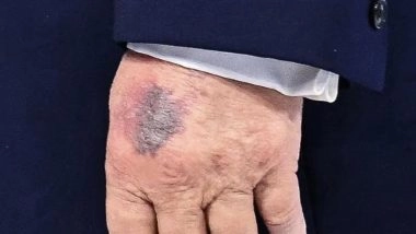 Why Does Donald Trump Have Bruises on His Hand? US President Clarifies Injury at Davos
