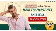 Business News | Celebrity Hair Transplant: You'd Never Guess They Had a Hair Transplant- But They Did
