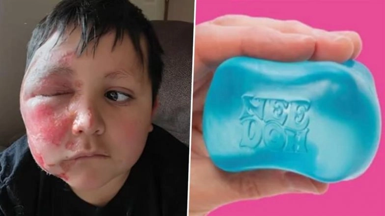 What Is Squishy Toy Trend on TikTok? Boy Suffers Severe Burns After Microwaving NeeDoh Toy in US