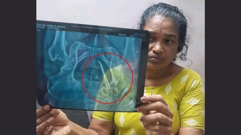 Kerala: Doctors Remove Surgical Forceps Left Inside Woman’s Body for 5 Years