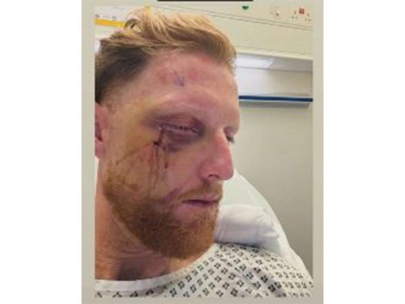 Sports News | England Test Captain Ben Stokes Undergoes Successful Facial Surgery