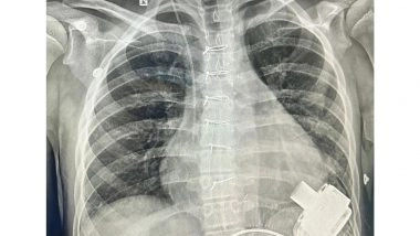 India News | Uzbeki Child with End-stage Heart Failure Recovers After Receiving Mechanical Heart (LVAD)