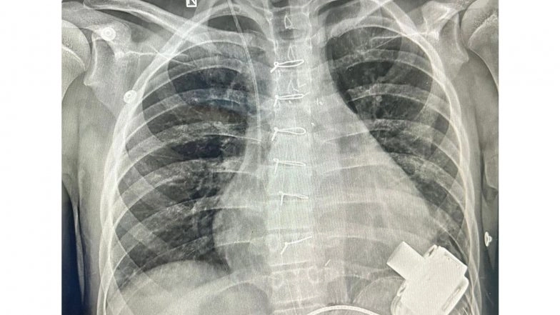 India News | Uzbeki Child with End-stage Heart Failure Recovers After Receiving Mechanical Heart (LVAD)