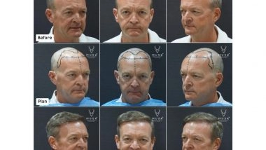 Business News | India's Medical Tourism Boom: How Musk Clinic is Shaping the Global Aesthetics & Hair Restoration Demand