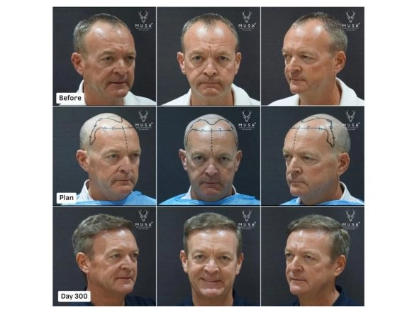 Business News | India's Medical Tourism Boom: How Musk Clinic is Shaping the Global Aesthetics & Hair Restoration Demand