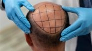 Hair Transplant Gone Wrong: Bengaluru Man Wins Refund After Clinic Gives Wig Instead