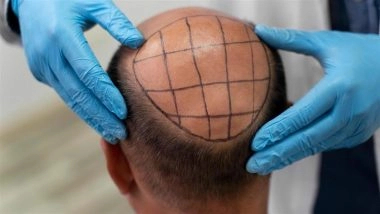 Hair Transplant Gone Wrong: Bengaluru Man Wins Refund After Clinic Gives Wig Instead