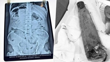 UP Man Hospitalised After Inserting Plastic Bottle Into His Private Parts, Surgery Saves Life in Ambedkarnagar