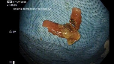 India News | Laser to the Rescue: Delhi Doctors Vaporise Stuck Denture to Save Patient from Major Surgery