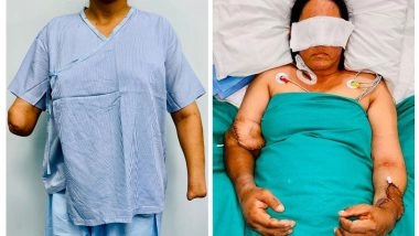 India News | Hand Transplant Gives New Life to Young Mother Who Lost Both Hands in Chaff-cutting Machine Accident
