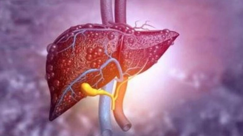 Delhi: 10-Year-Old Girl Suffers Liver Failure in Burari After Excessive Momos Consumption; Shows Memory Loss and Mobility Issues