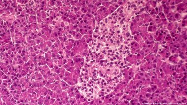 Pancreatic Cancer: New Drug Extends Lives but Isn't a Cure