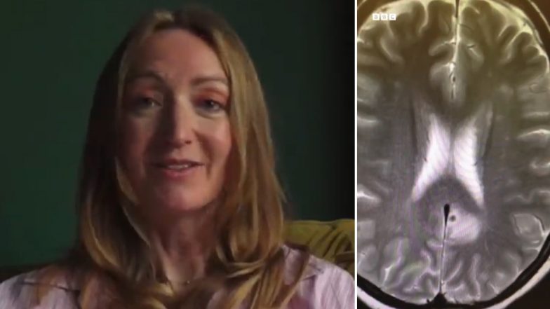 What Is Neurocysticercosis? Brain Infection Diagnosed After UK Woman&rsquo;s India Trip