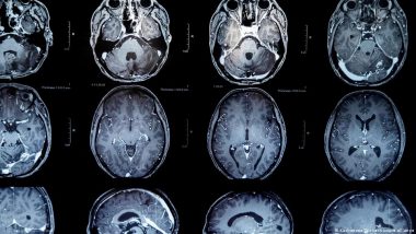 Brain Tumors: New Vaccine Offers Patients Hope for More Time
