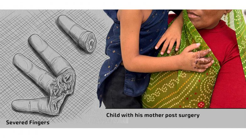 Business News | Zydus Hospital, Ahmedabad's Surgeons Reattach Toddler's Severed Fingers in a 12-Hour Race Against Time