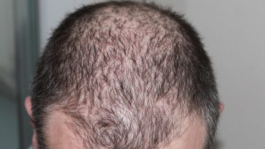 Hair Loss, Confidence and Regenerative Care: What to Know Before PRP, Exosomes and Stem Cell Claims