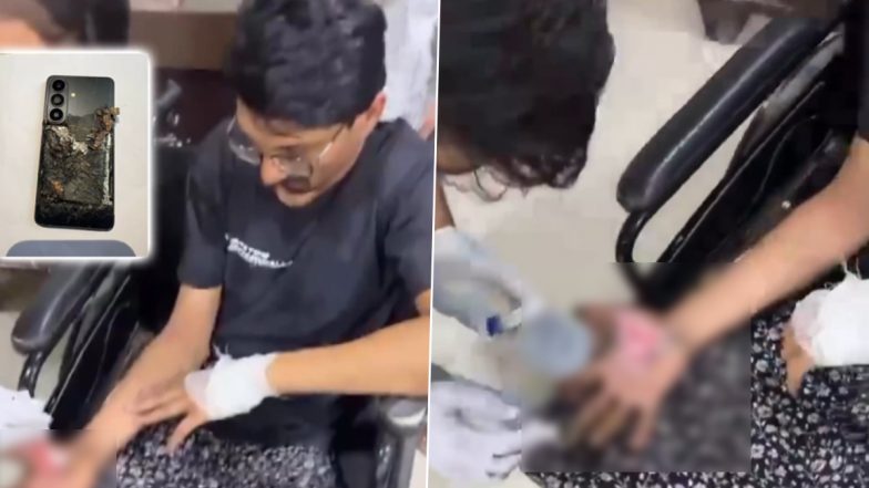 Samsung Phone Explodes in Youth's Pocket in Greater Noida, Leaves Him Injured (Watch Videos)