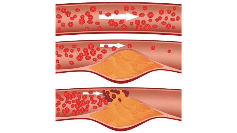 What Do the New 2026 US Cholesterol Guidelines Mean for Heart Health?