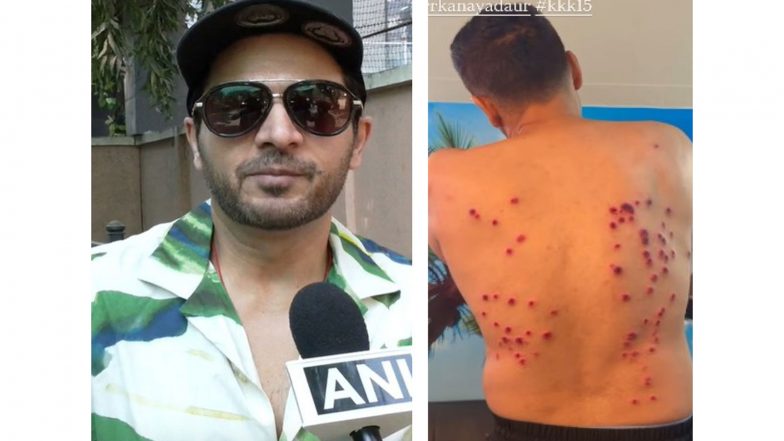 Entertainment News | Khatron Ke Khiladi: Gaurav Khanna Suffers Severe Laser Burns During Task, Leaves Fans Concerned