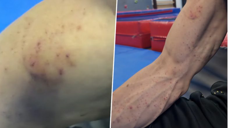 Tiger Shroff&rsquo;s Team Shares Video of Injury Marks on Actor&rsquo;s Arm After Firing Incident