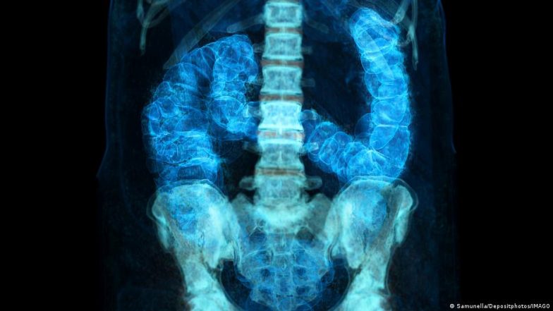 Early-onset Cancer: Why Cases Are Rising in Under-50s