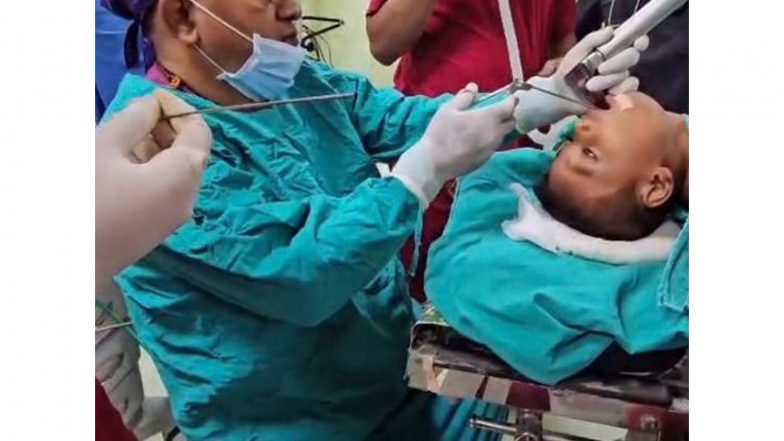 India News | Four-year-old Boy’s Life-saving Treatment at AGMC: Coin Removed Successfully from Food Pipe on Lakshmi Puja Holiday